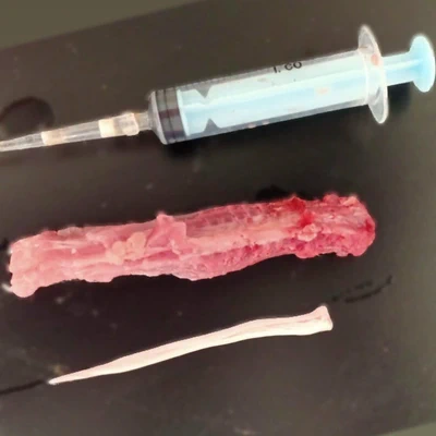 Spinal cord isolation by hydraulic extrusion.